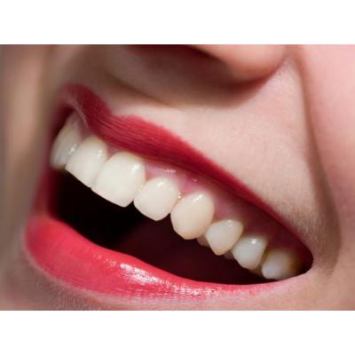 Tất tần tật những điều bạn nên biết trước khi bọc răng sứ - Giá bọc răng sứ chuẩn nhất 2021